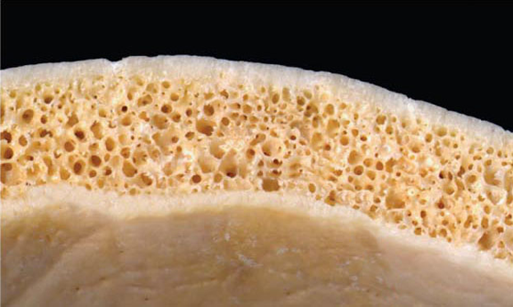 Bone from the top of a human skull has a dense outer layer (top), a dense inner layer, and a spongy-looking middle layer. A tiny magnetic device placed on the inner layer will be able to stimulate and sense brain cells without injuring the brain or exposing it to infection.