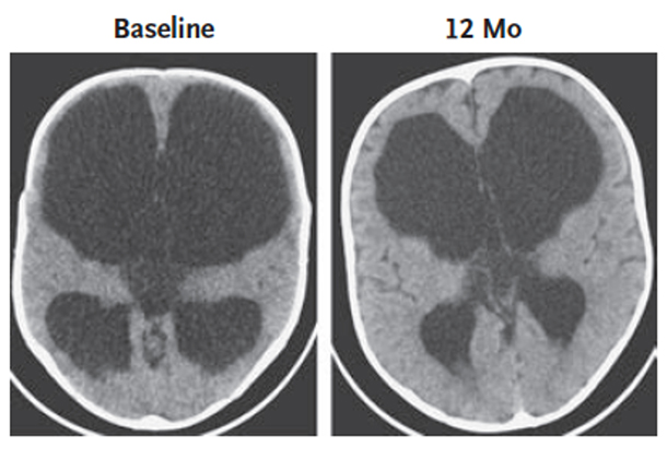 CT scans of infant brains.  Scan on the left shows infant’s brain before endoscopic surgery (ETV-CPC).  Scan on the right shows 12-month postoperative scan of the same infant’s brain.