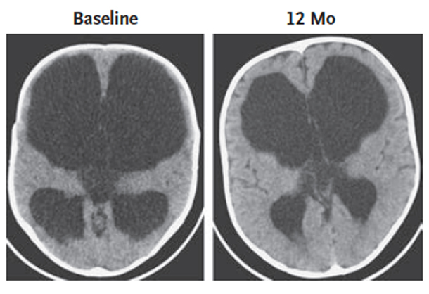 CT scans of infant brains. Scan on the left shows infant’s brain before endoscopic surgery (ETV-CPC). Scan on the right shows 12-month postoperative scan of the same infant’s brain.
